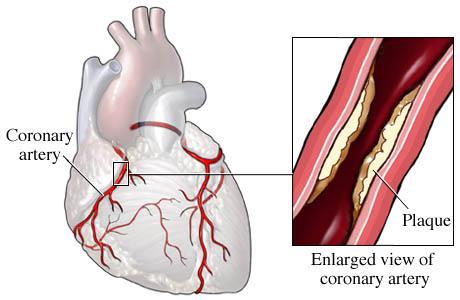 Exercise-related triggers for plaque instability Increased coronary artery wall stress Spasm of the diseased segment of coronary artery Ischemiainduced