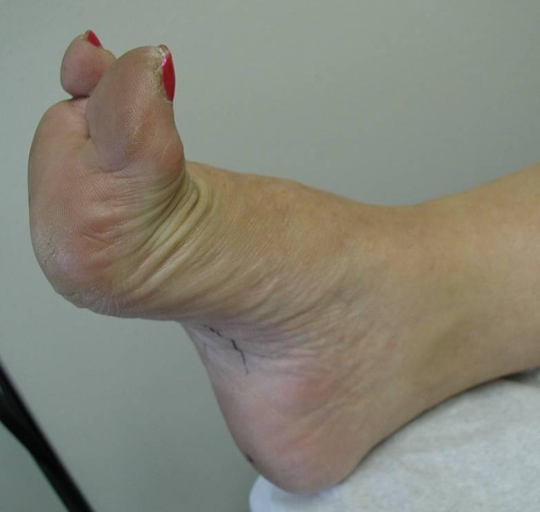 Cavus = High Arch Forefoot Plantarflexed on Rearfoot Normal Ankle