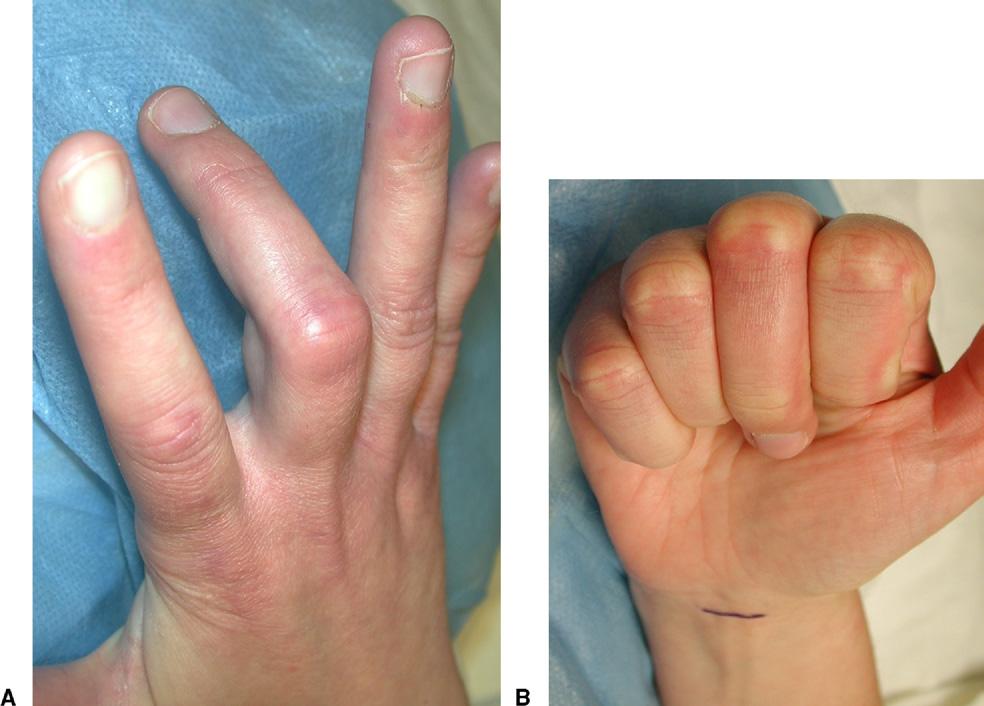 PULLEY RUPTURE FOLLOWING STEROID INJECTION 1445 FIGURE 1: Clinical photographs of the patient s affected hand at time of presentation to our institution, showing A the 55 flexion contracture and B