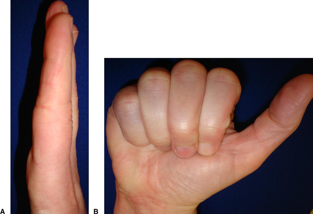 PULLEY RUPTURE FOLLOWING STEROID INJECTION 1447 FIGURE 5: At 15 months after surgery, the patient has A only 5 flexion contracture at the DIP and PIP joints and B near full composite flexion.