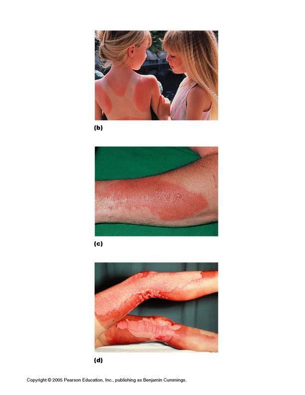 Burns First-degree: epidermis only; redness Second-degree: epidermis and dermis, with