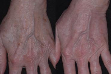 POLDER ET AL to 50% improvement. Investigators rated improvement in lentigines as 3.33 7 0.89, fine wrinkling as 1.75 7 1.06, and mottled hyperpigmentation as 3.33 7 0.89 (Table 2).