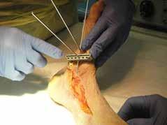 The osteotomy is a plantar medial based bi-planar wedge that is designed to correct abduction and arch collapse.