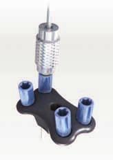 Lateral Column Lengthening Plate Screw heads are recessed into the plate providing an overall low profile construct with either Locking or