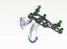 Medial Column Fusion Plate TiMAX for strength, biocompatibility and
