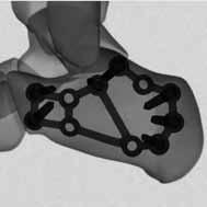 Approach, Reduction and Plate Placement Step 1: Approach The calcaneus is approached through an extensile lateral incision which minimizes the sequelae of peroneal tendinitis and devascularization of