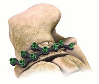 Approach, Reduction and Plate Placement Step 1: Approach Make a dorsal longitudinal incision from the midneck of the talus towards the base of the second metatarsal.