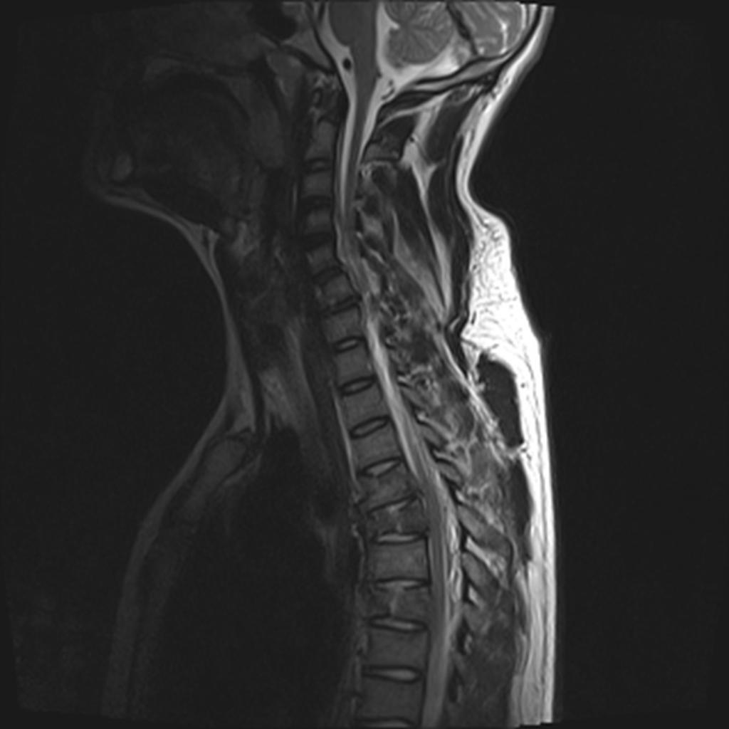 Fig. 2: Sagittal T2 of the cervico-thoracic region: