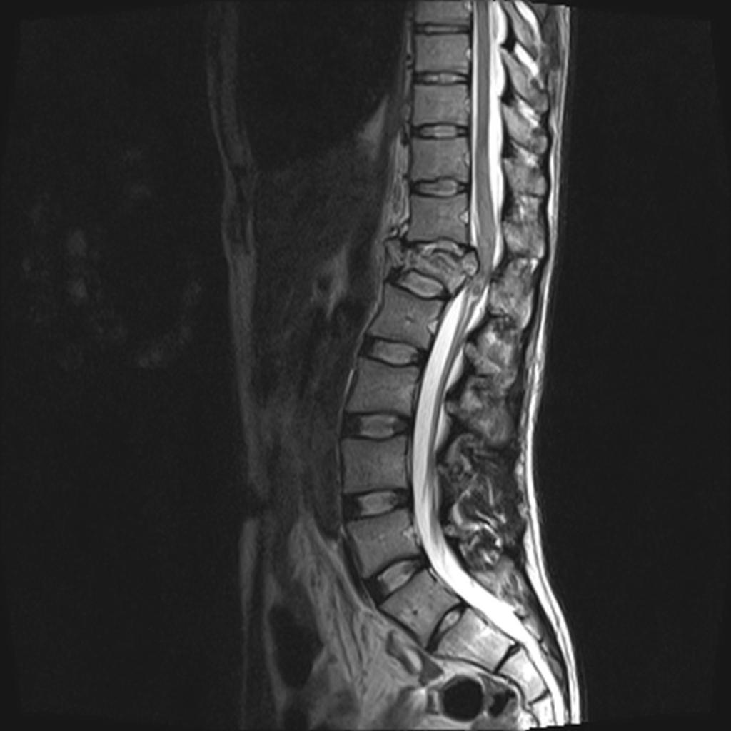 Fig. 3: Sagittal T2 of the thoracolumbar spine demonstrating a T12 fracture with resultant severe spinal canal