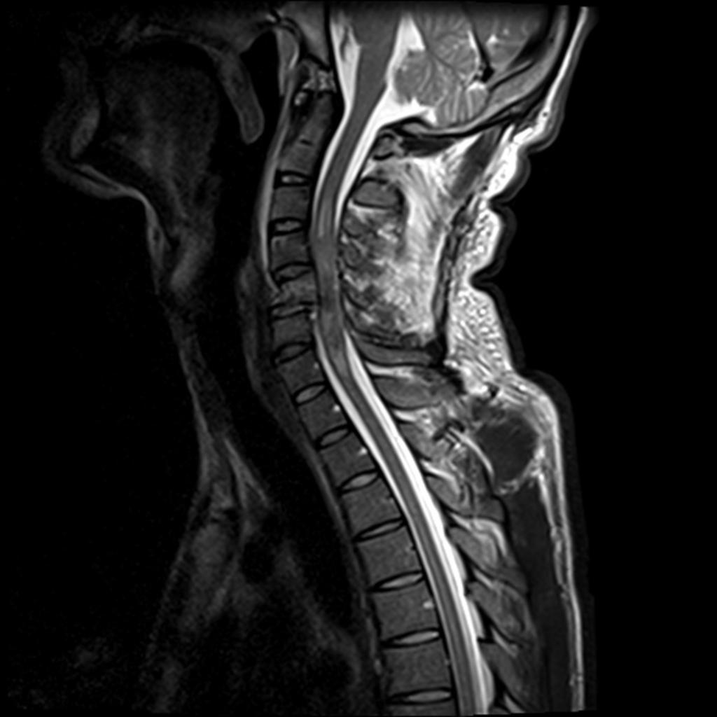 Fig. 4: Sagittal T2 of the cervical spine demonstrating retrolisthesis of C5 on C6 with a torn posterior