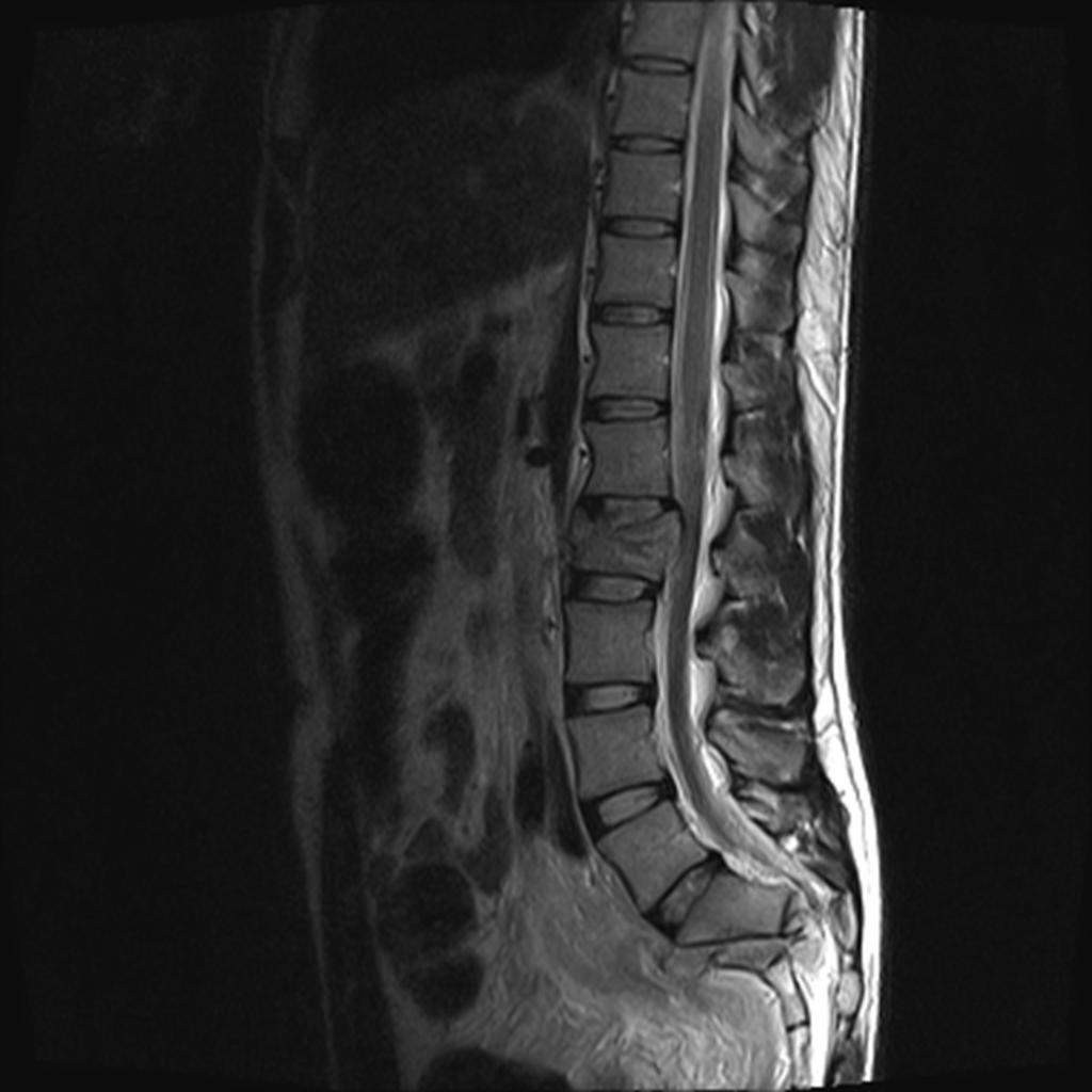 Fig. 1: Sagittal T2 lumbar spine: Two level injury: The obvious abnormality at L2