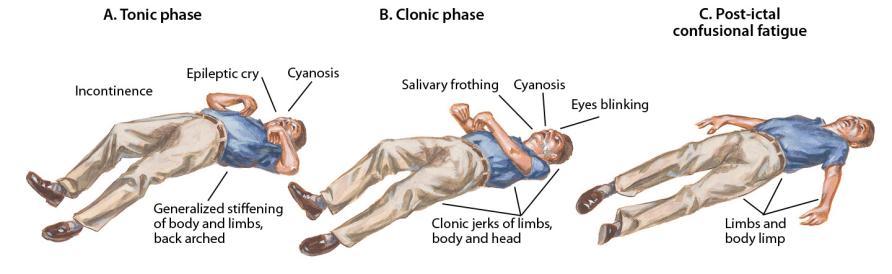 Tonic-clonic seizure