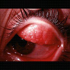 Rebamipide attenuates giant papillae in patients with allergic conjunctivitis like VKC/AKC VKC: Vernal keratoconjuctivitis is chronic,