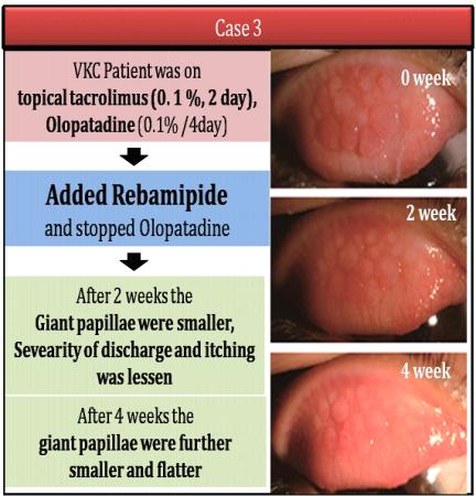 Rebamipide attenuates giant papillae in patients with allergic conjunctivitis like VKC/AKC VKC patient was on Fluromothalone ( 0.1%) 4/ day, Olopatadine (0.