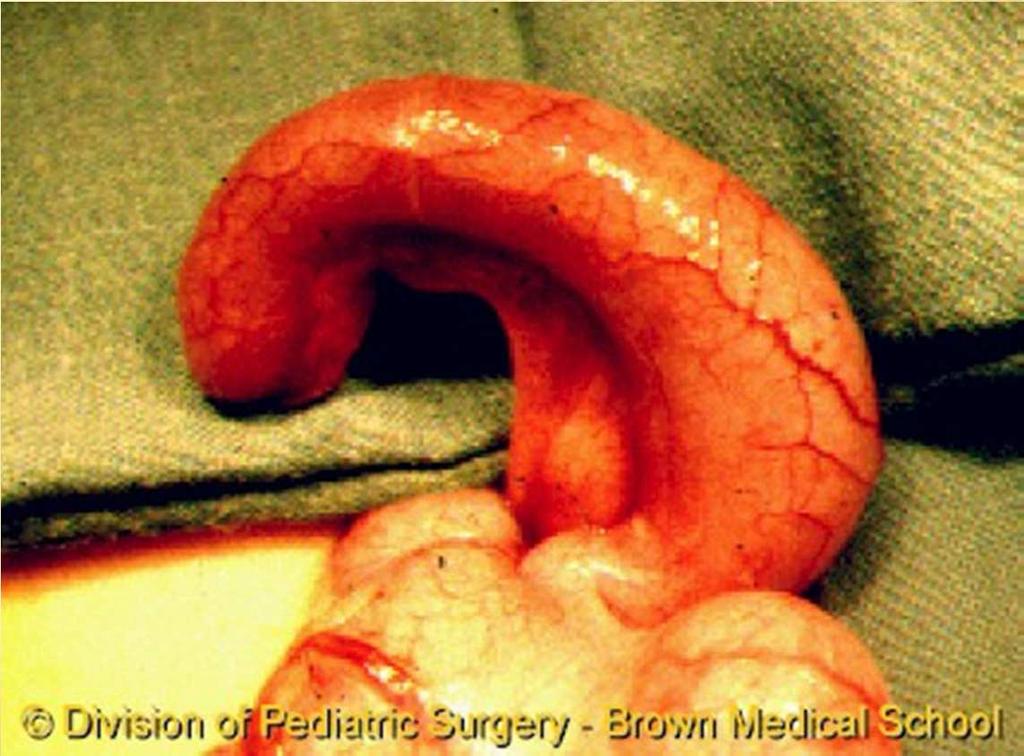 APPENDICITIS When appendix becomes inflamed If it