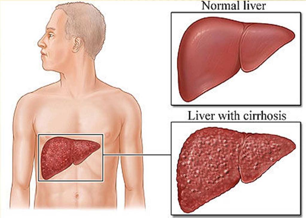 CIRRHOSIS Chronic, progressive disease of liver Normal tissue replaced