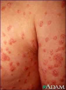 Guttate psoriasis Tear drop lesions Associated with B23, B17 and