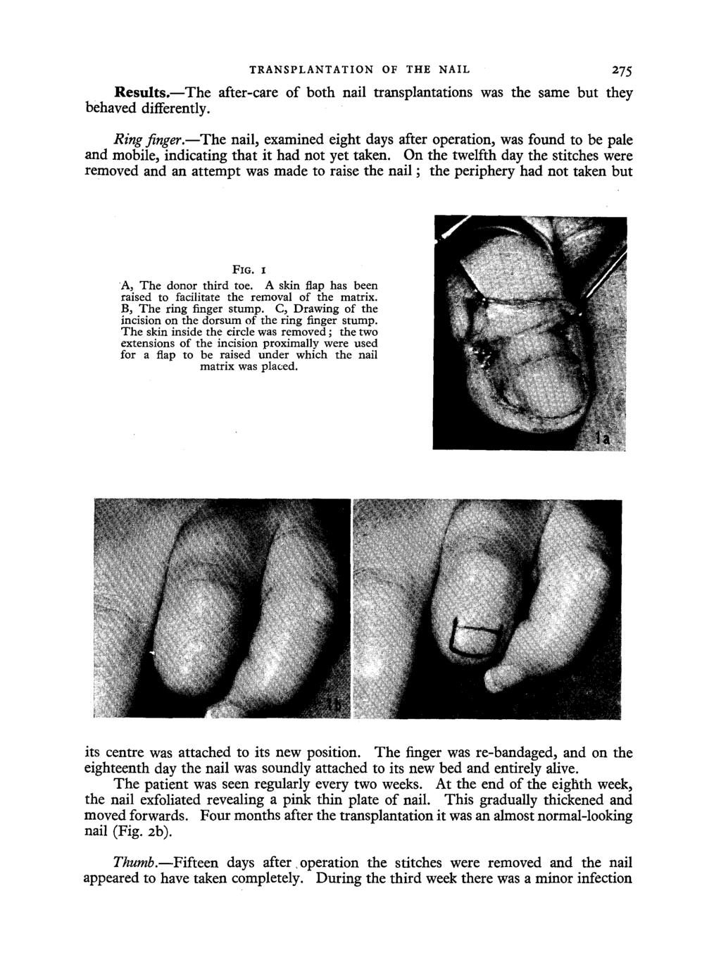 TRANSPLANTATION OF THE NAIL Results.--The after-care of both nail transplantations behaved differently. 275 was the same but they Ring finger.