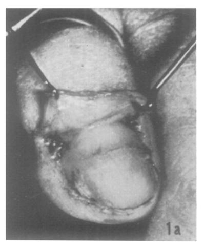 On the twelfth day the stitches were removed and an attempt was made to raise the nail ; the periphery had not taken but FIG. I A, The donor third toe.
