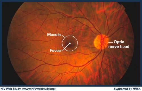 Central Retinal Artery Occlusion Ocular exam Cherry red spot on