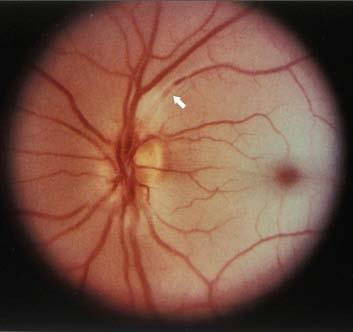 so the macula appears pink and healthy against the ischemic retina)
