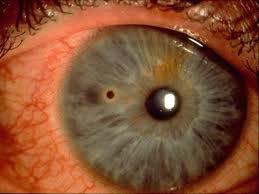 injection & lid/corneal edema +/-flare ant