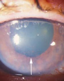 Diagnostic testing Visual Acuities Slit-lamp exam Depth of anterior chamber If <¼ of the corneal thickness, then chamber is