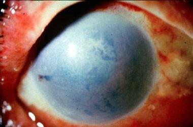 Chemical Burns Presentation Eye pain, limited visual acuity Corneal cloudiness Scleral whitening Eye may be erythematous or whitened