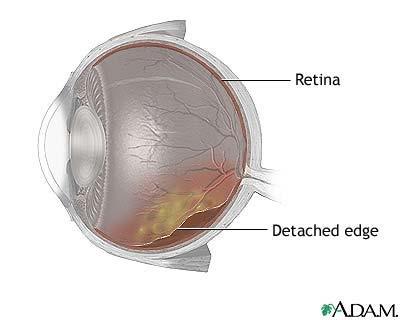 Physical Findings Afferent pupillary defect is possible CHECK for