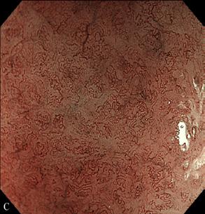In intramucosal cancers, cancer cells of the surface mucous cell type and the pyloric gland cell type show a laminar distribution resembling normal pyloric gastric mucosa.