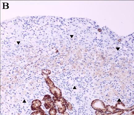 The histological diagnosis and judgment of cellular differentiation of cancer cells was accomplished by a pathologist who was blinded to the endoscopic findings.