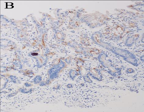 Results Correlation between M-NBI findings and organoid differentiation (Table 2) All 19 cases with the CLP and 36 cases with the FNP were differentiated adenocarcinoma, and no bias was noted in the