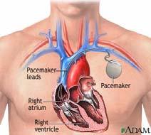 Implanted Cardiac Devices Implanted cardiac pacemakers ICPs provide small electrical stimuli to case cardiac contraction during periods of bradycardia, when the intrinsic electrical activity of the