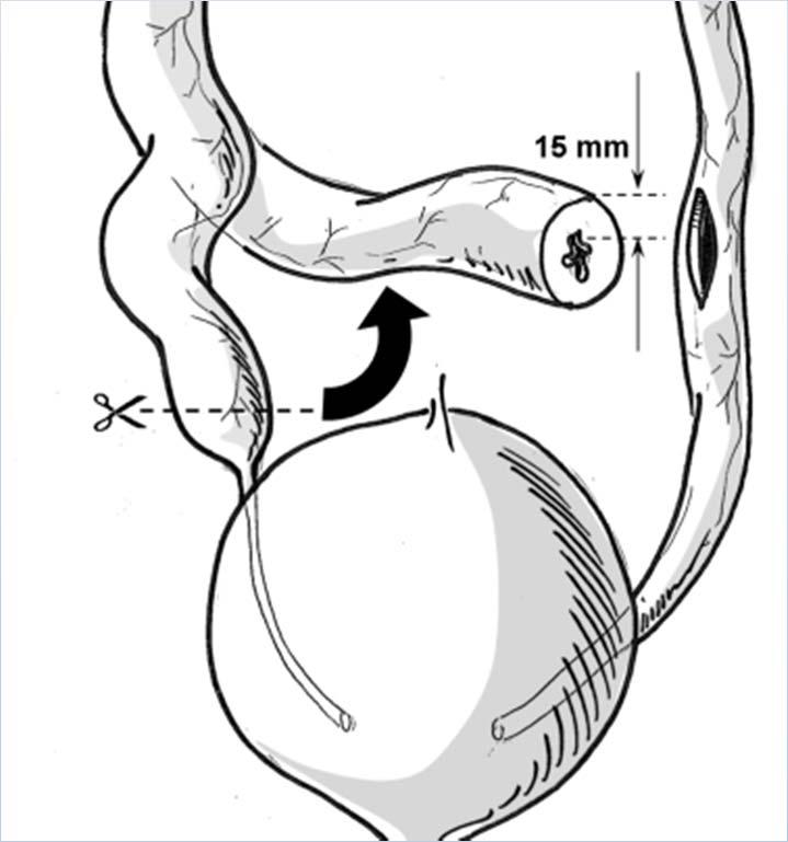 Successive steps explained in a single image 1. Cut the right ureter above the obstruction 2.