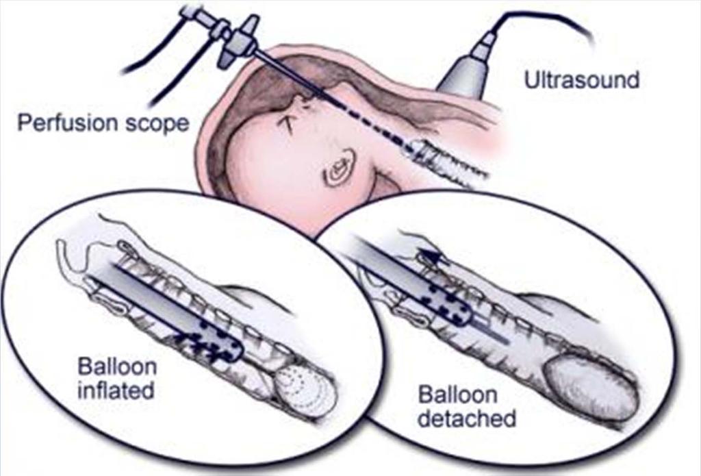 Fetal tracheal occlusion
