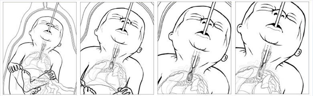 Fetal tracheal occlusion to treat lung hypoplasia 4 images seem essentially the same Shows
