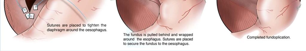 Free the esophagus and place sutures in the diaphragm