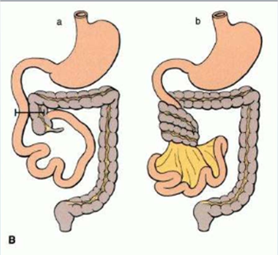 Intestinal malrotation and volvulus Normal