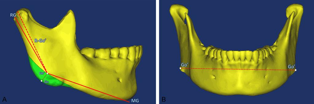 Figure 1. Observation of mandibular ramus and mandibular width by using Mimics software. A.
