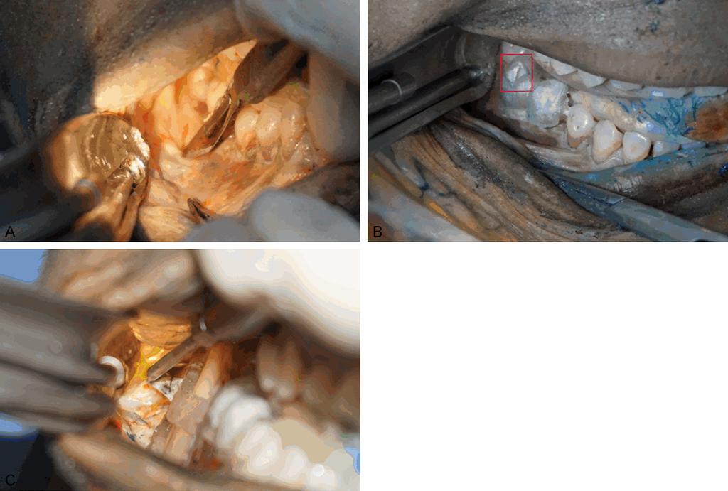 Figure 2. Surgical procedures. A. Incision of oral mucosa. B. Embed the upper part of template in teeth and observe (red square) whether the template fit closely with teeth or not. C.