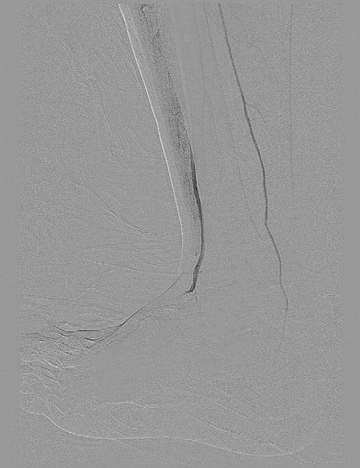 113.e4 Case reports Annals of Vascular Surgery Fig. 5. Angiogram of Right Lower Extremity during Active Dorsiflexion of Foot. Fig. 7. Normal Pedal Anatomy: Ext.
