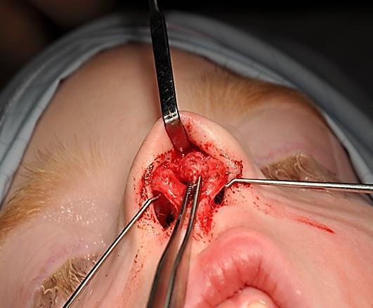 surgery or recurrent infection or with intracranial extension. A separate excision of a sinus opening may be required; with intracranial extension a combined intracranial ap-proach may be required. C.