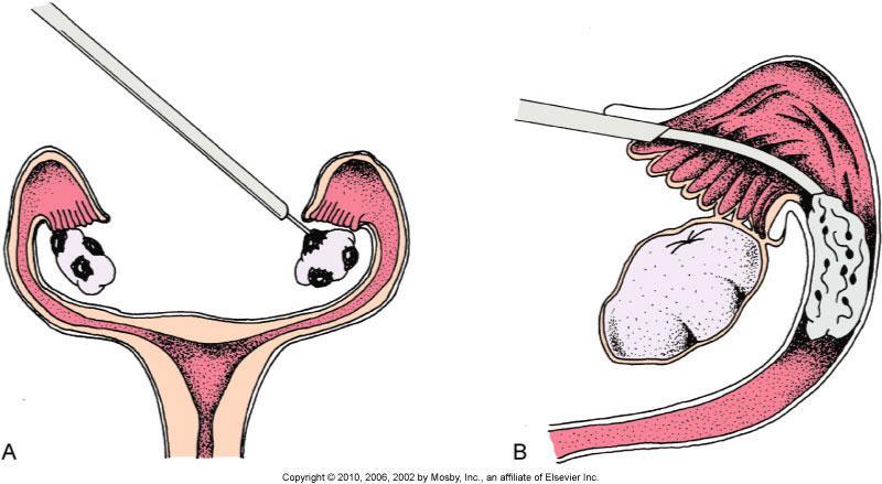 Fig. 7-4. Gamete intrafallopian transfer (GIFT).