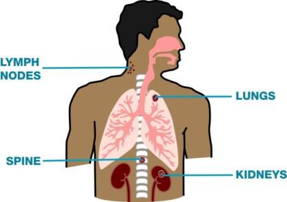 DISSEMINATION: Spread of TB to Other Parts of the Body ITECH, 2006 1. Lungs (85% all cases) 2. Pleura 3.