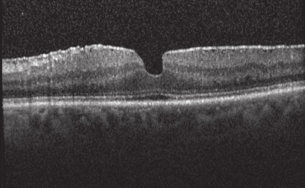 ERMs can be associated with a number of ocular conditions such as prior retinal tears or detachment, retinal vascular diseases such as diabetic retinopathy or venous occlusive disease; they can also