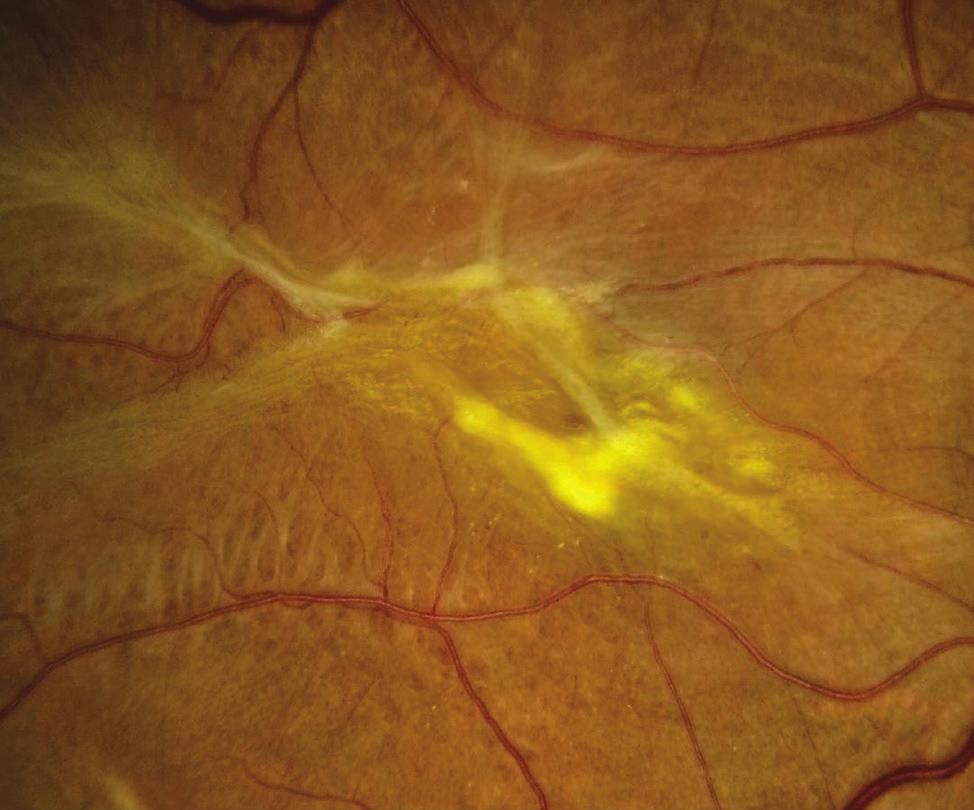 the retina, relieving the traction and clearing up the vision. However, if an exam shows progression and/or functional worsening in vision, surgical intervention maybe recommended.