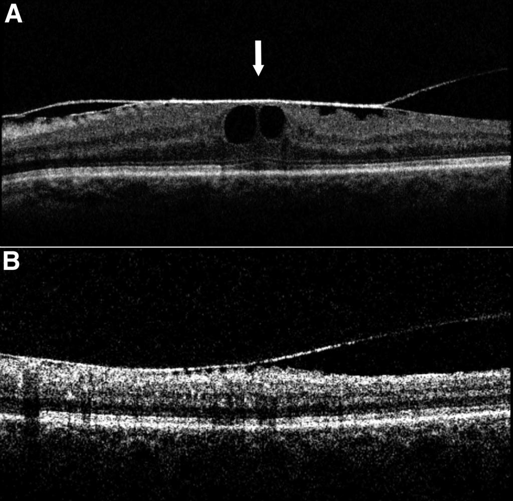 Based on these observations, which can be supported by histologic findings, 7 it can be assumed that the hyperreflective adherent epimacular membrane is commonly composed of a united fibrocellular