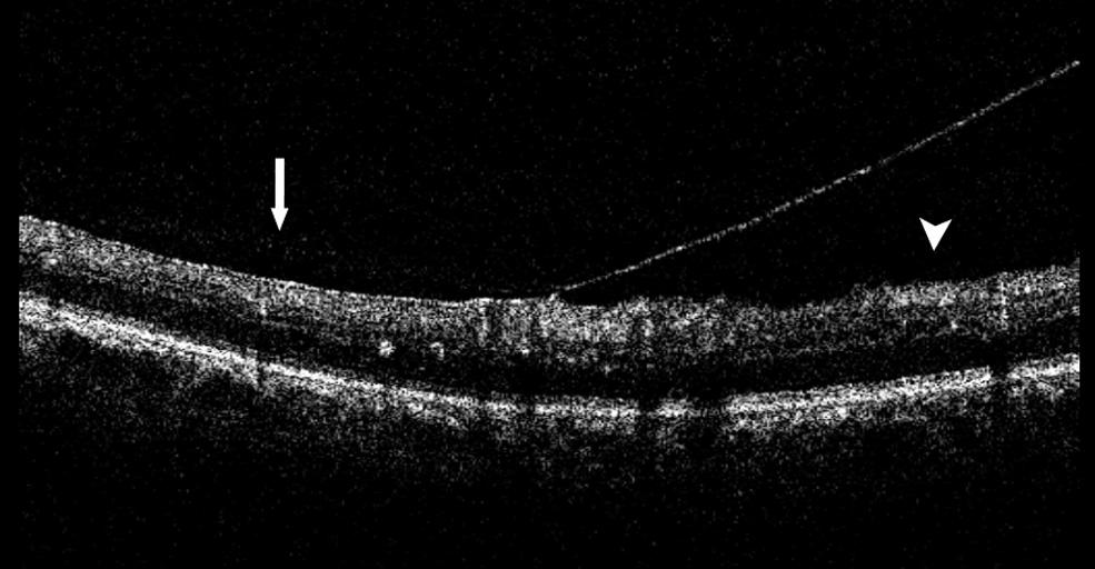 6418 Ophir and Martinez IOVS, August 2011, Vol. 52, No. 9 FIGURE 5. An 81-year-old patient (subgroup B-IV) with DME in his left eye (patient 21).