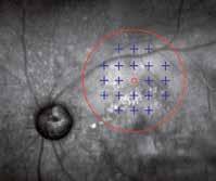 In normal subjects the retinal area predominantly used for fixation is the fovea, whereas when pathology affects the central retina, fixation degrades and patients may use extra-foveal regions.