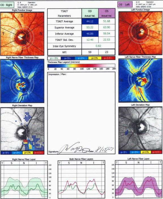 Confocal Laser Scanning Tomography with Polarimetry (GDx) GDx nerve fiber